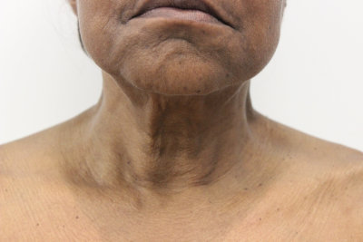 Neck Bands Treatment Murray Hill NYC